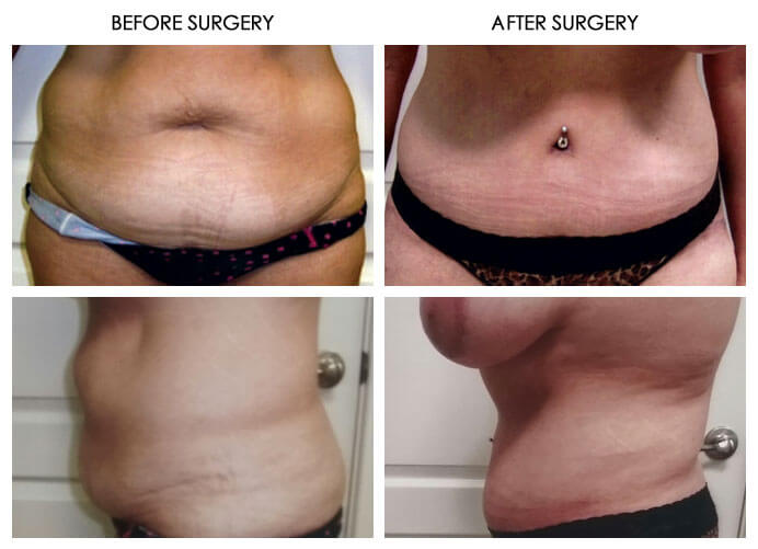 Body Plastic Surgery