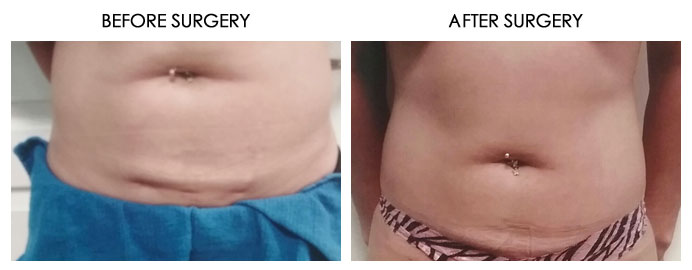 Body Plastic Surgery