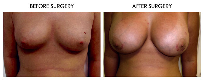 Breast Plastic Surgery