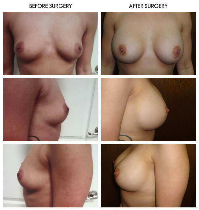 Breast Plastic Surgery