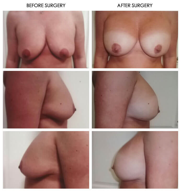 Breast Plastic Surgery