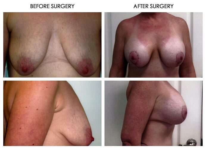 Breast Plastic Surgery