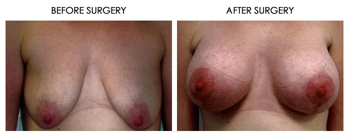 Breast Plastic Surgery