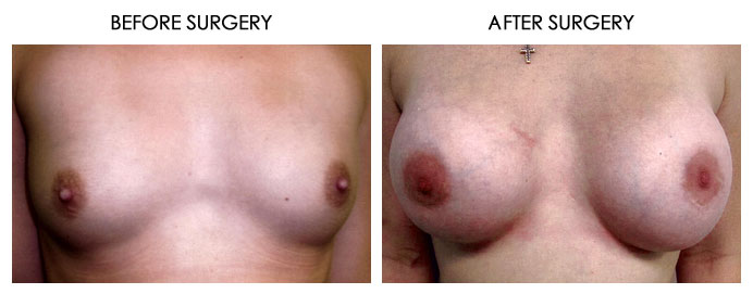 Breast Plastic Surgery