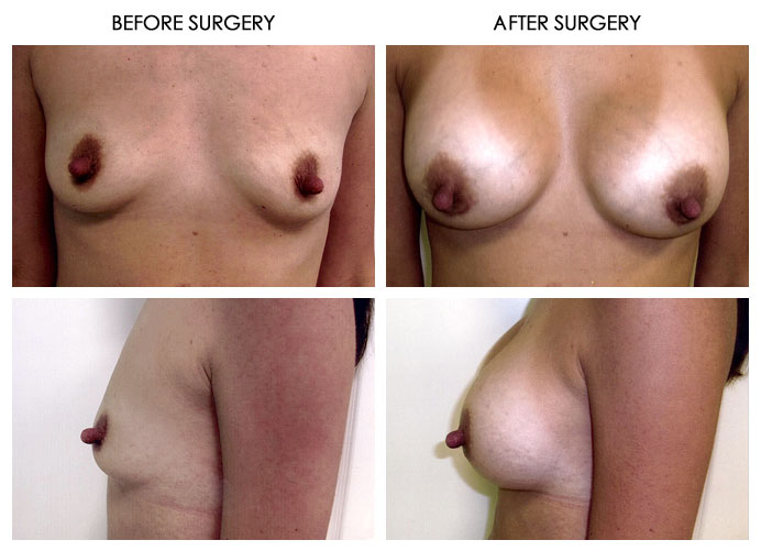 Breast Plastic Surgery