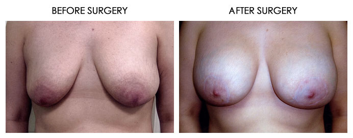 Breast Plastic Surgery