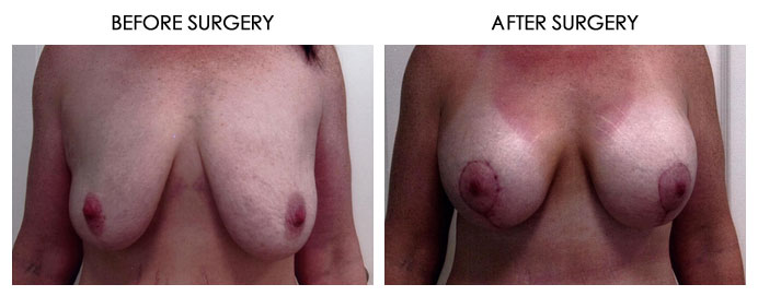 Breast Plastic Surgery