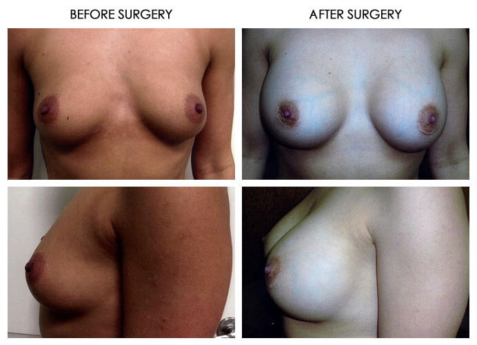 Breast Plastic Surgery