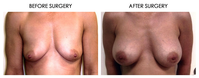 Breast Plastic Surgery