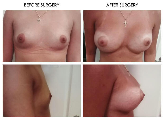 Breast Plastic Surgery