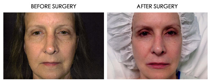 Facial Plastic Surgery