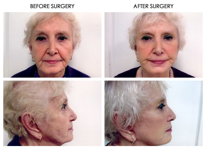 Facial Plastic Surgery