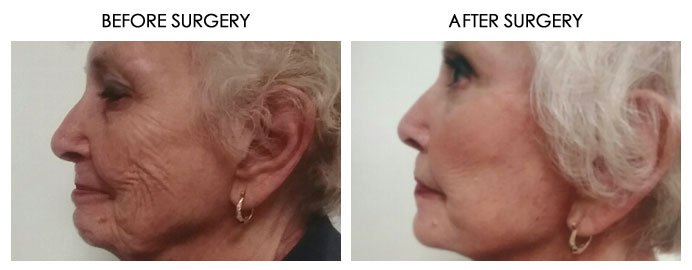 Facial Plastic Surgery