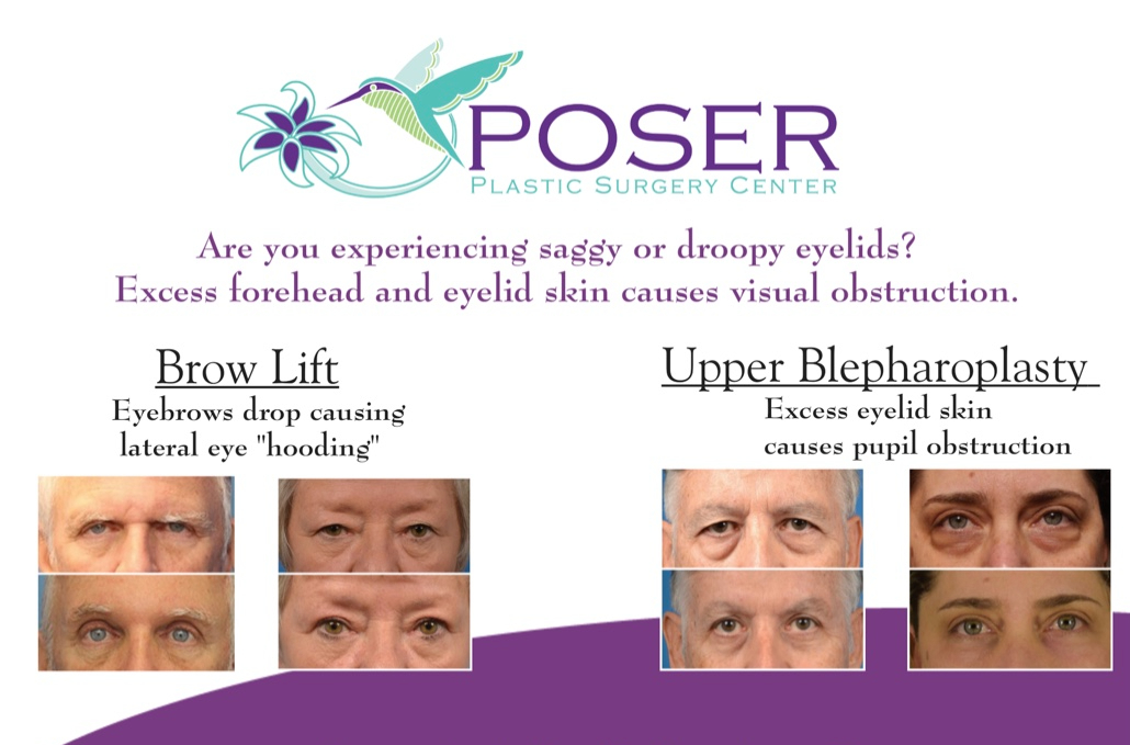 brow lift and upper blepharoplasty promotion